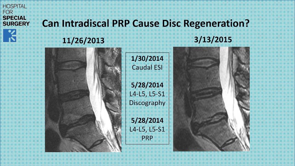 can-prp-regenerate-a-degenerative-disc